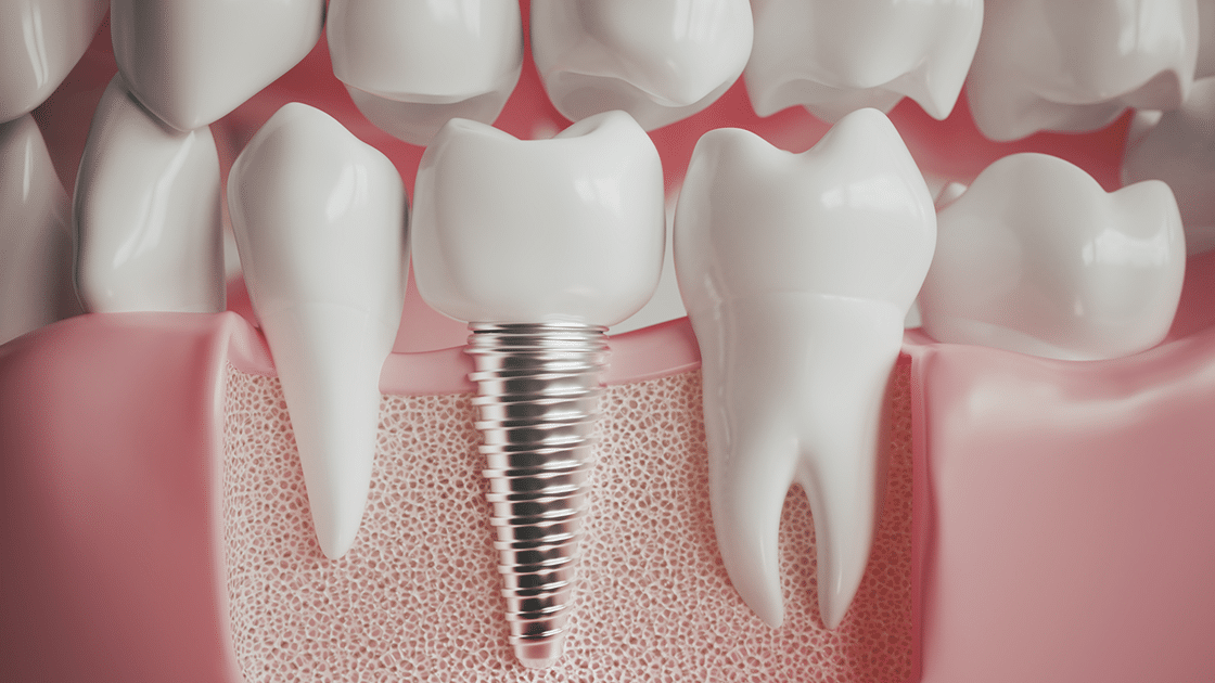 Dental Implant